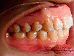 результат ортодонтического лечения, вид справа