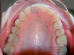 результат ортодонтического лечения, верхняя челюсть