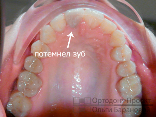 потемнение переднего зуба может быть вызвано воспалением в каналах