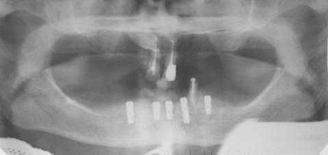 обзорный рентгеновский снимок челюсти