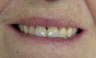 пациентка довольна проведенным протезированием зубов.