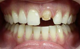 откол переднего зуба - подготовка к реставрации зуба