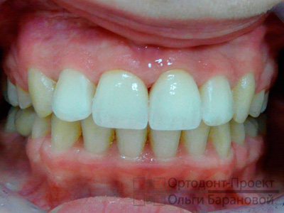 вид зубов после комплексного лечения и коррекции