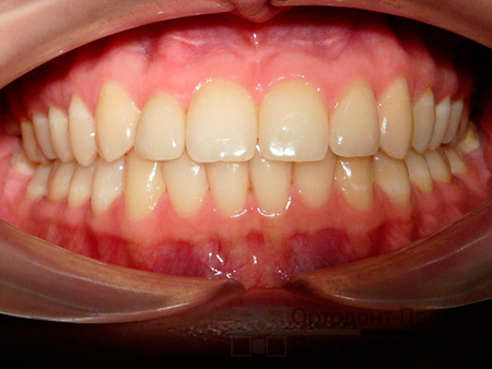 ортодонтическое лечение на системе Инсигния и протезирование вторых резцов