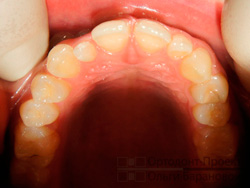 фото до лечения у ортодонта