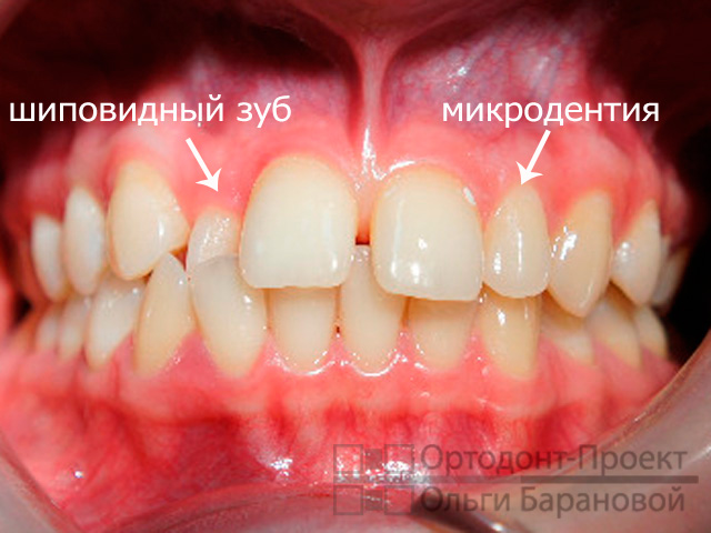 неправильная форма зубов, которую надо исправить