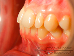 фото до лечения у ортодонта - слева