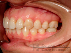 вид слева после ортодонтического лечения