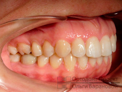 вид справа после ортодонтического лечения