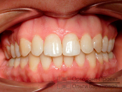 зубы после ортодонтического лечения