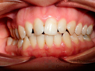 зубы до ортодонтического лечения