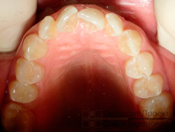 верхние зубы до ортодонтического лечения