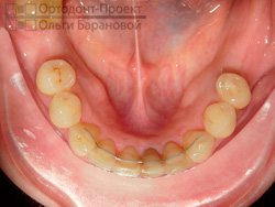 нижние зубы после лечения