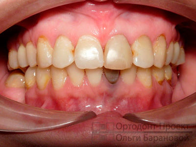 вид зубов спереди после лечения