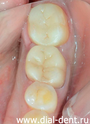лечение кариеса и реставрация зубов керамическими вкладками