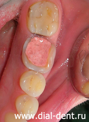 кариес зубов, разрушение старой пломбы
