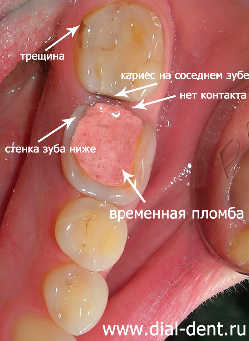 кариес зубов, старые пломбы