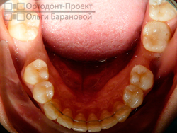 результат лечения у ортодонта