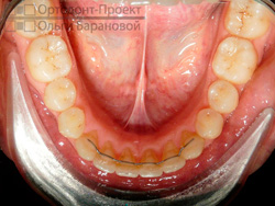 после ортодонтического лечения - нижняя челюсть