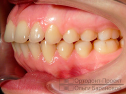 после ортодонтического лечения - вид слева