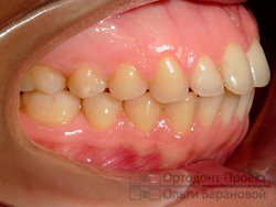 после ортодонтического лечения - вид справа
