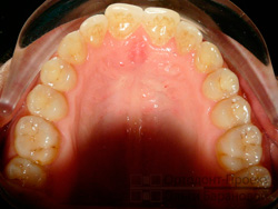 после ортодонтического лечения - верхняя челюсть