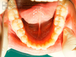 до ортодонтического лечения - нижняя челюсть