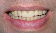улыбка пациента стоматологической клинике Диал-Дент Павелецкая