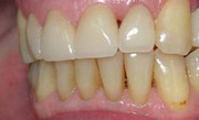 Отреставрированные зубы, вид справа