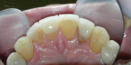 художественная реставрация зубов Стоматологическая клиника Диал Дент