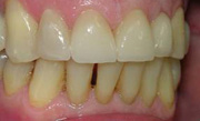 Отреставрированные зубы, вид слева