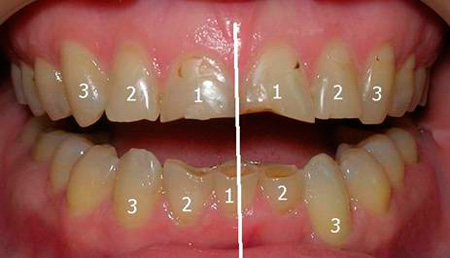 ошибка ортодонтического лечения - невосполнение отсутствующего зуба
