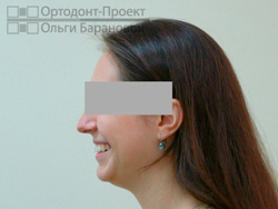 вид в профиль после ортодонтического лечения