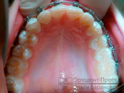 ортодонтическое лечение на брекетах