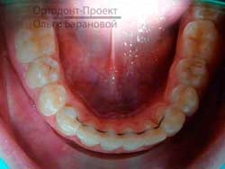 нижние зубы после ортодонтического лечения