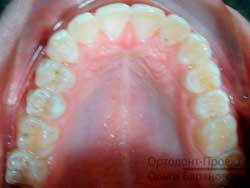 верхние зубы после ортодонтического лечения