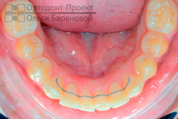 результат ортодонтического лечения - нижний зубной ряд