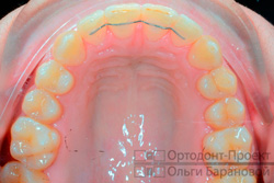 результат ортодонтического лечения - верхний зубной ряд