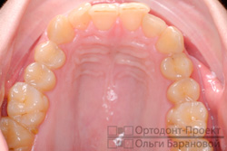 скученность зубов верхней челюсти, повышенная стираемость центральных зубов