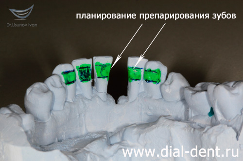 планирование препарирования зубов на диагностической модели