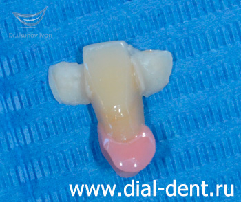 мостовидный протез переднего зуба