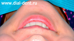 протезирование зубов коронками из диоксида циркония в "Диал-Дент"
