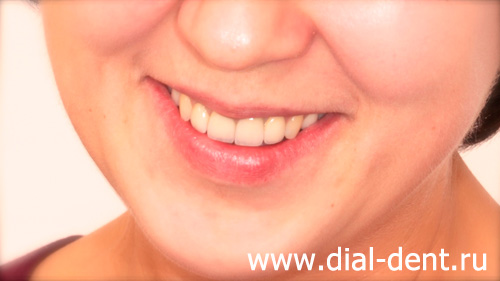 результат протезирования зубов в "Диал-Дент" коронками из диоксида циркония