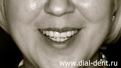 результат протезирования зубов в "Диал-Дент" коронками из диоксида циркония