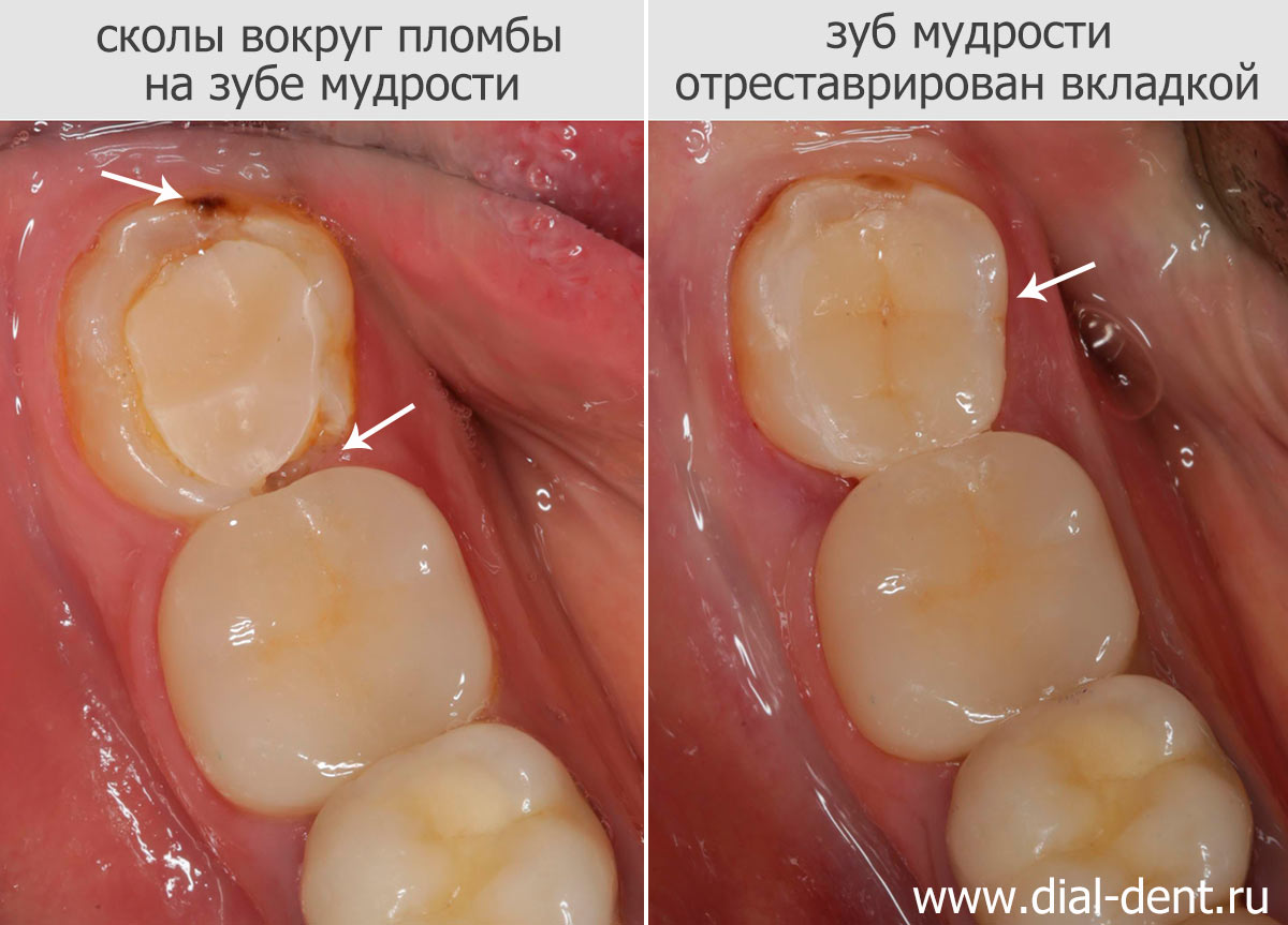 зуб мудрости до и после лечения кариеса и замены пломбы на вкладку