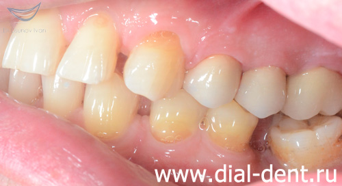 восстановление зубов коронками из диоксида циркония