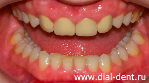 неэстетичное протезирование передних зубов