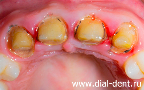 неправильная подготовка зубов под протезы, воспаление десен под старыми протезами
