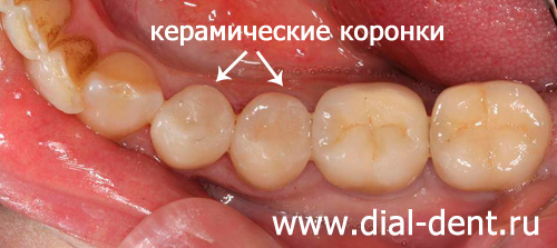 восстановление зубов керамическими коронками