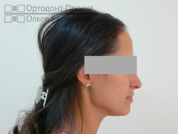 профиль в результате нейромышечного и ортодонтического лечения